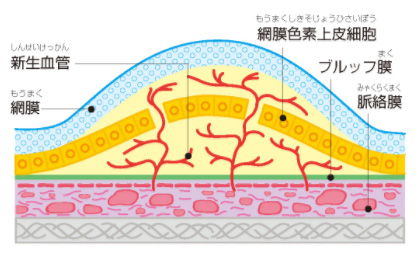 網膜の下にある脈絡膜から発生する新生血管の様子を説明したイラスト