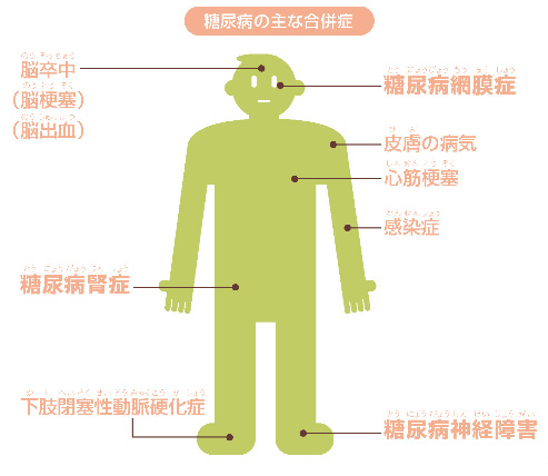 糖尿病の主な合併症を説明したイラスト