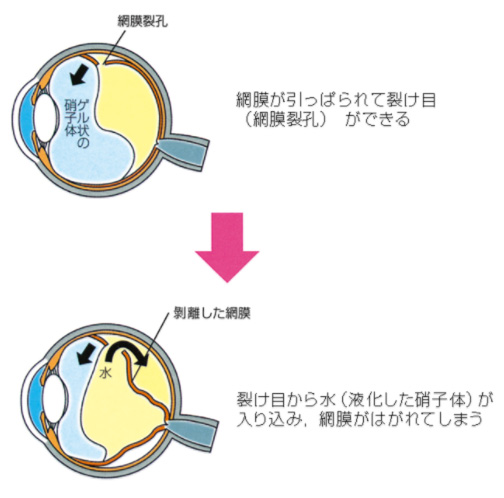 網膜剥離の仕組みを説明したイラスト。網膜が引っぱられて裂け目（網膜裂孔）ができる。裂け目から水（液化した硝子体）が入り込み、網膜がはがれてしまう。