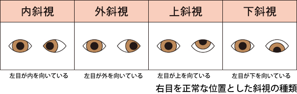 右目を正常な位置とした斜視の種類