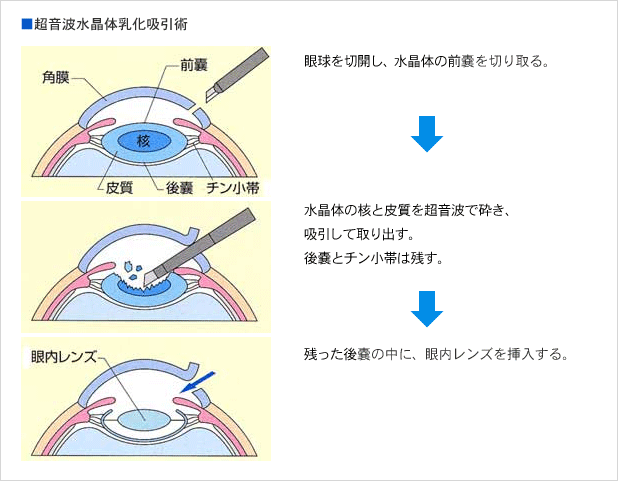 超音波水晶体乳化吸引術のイラスト。1.眼球を切開し、水晶体の前嚢を切り取る。2.水晶体の核と皮質を超音波で砕き、吸引して取り出す。3.残った後嚢の中に、眼内レンズを挿入する。