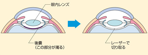 レーザーを使って濁りを取るイラスト